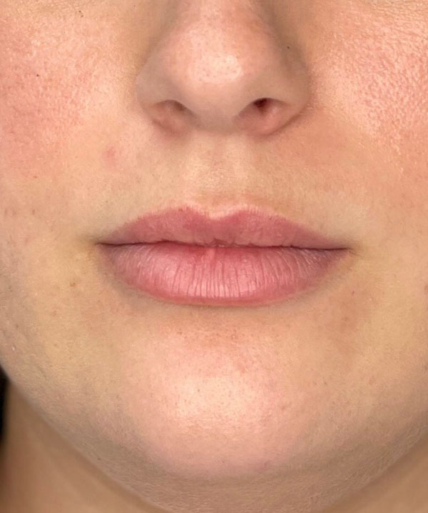 lip filler in Tampa